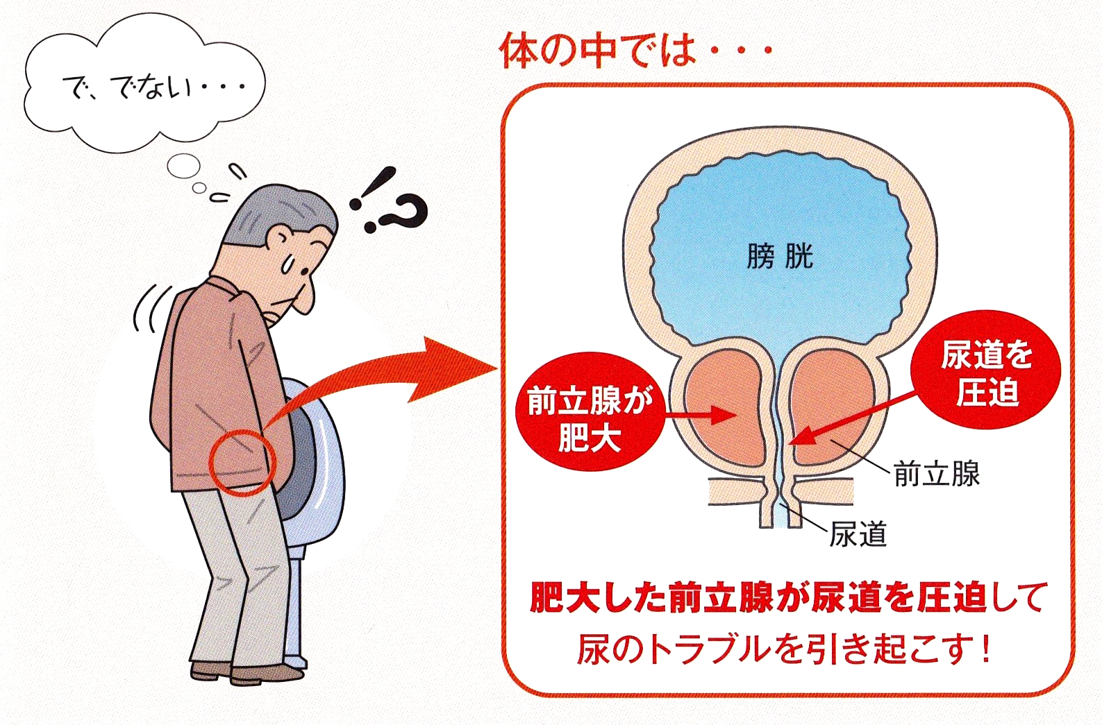 薬 前立腺 肥大 症