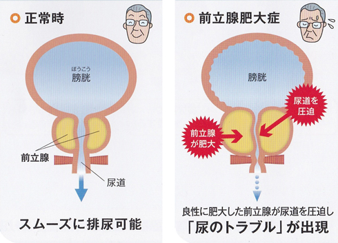 前立腺肥大症とは