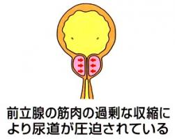 前立腺の筋肉の過剰な収縮により尿道が圧迫されている