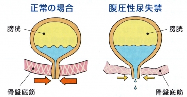 腹圧性尿失禁　原因