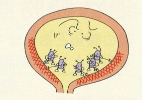 感染症（膀胱炎や尿道炎など）