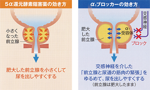 前立腺肥大症 薬物療法 薬による違い 効き方