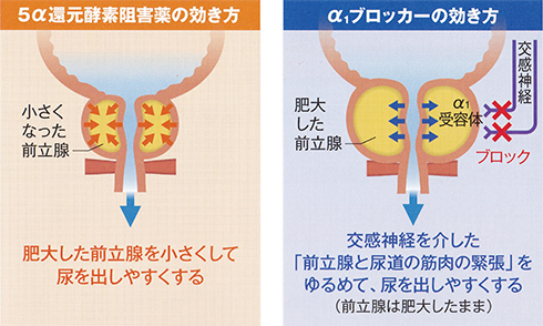 5-αリダクターゼ阻害剤