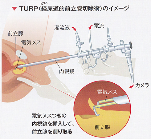 前立腺肥大症 治療 内視鏡手術 TRUP