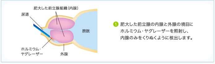 前立腺肥大症 治療 内視鏡手術 HoLEP