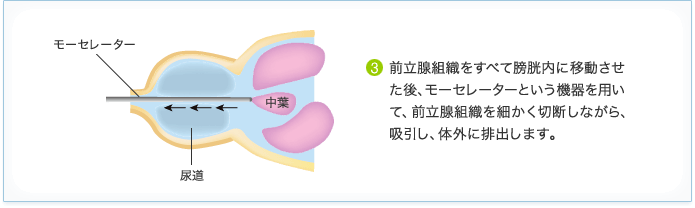 前立腺肥大症 治療 内視鏡手術 HoLEP