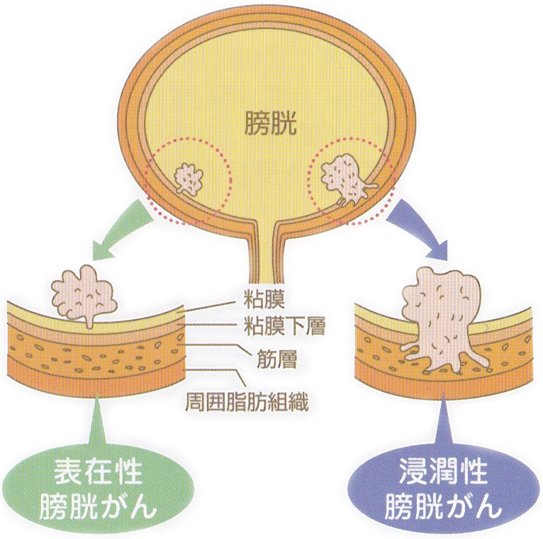 膀胱がん 表在性 湿潤性 治療法