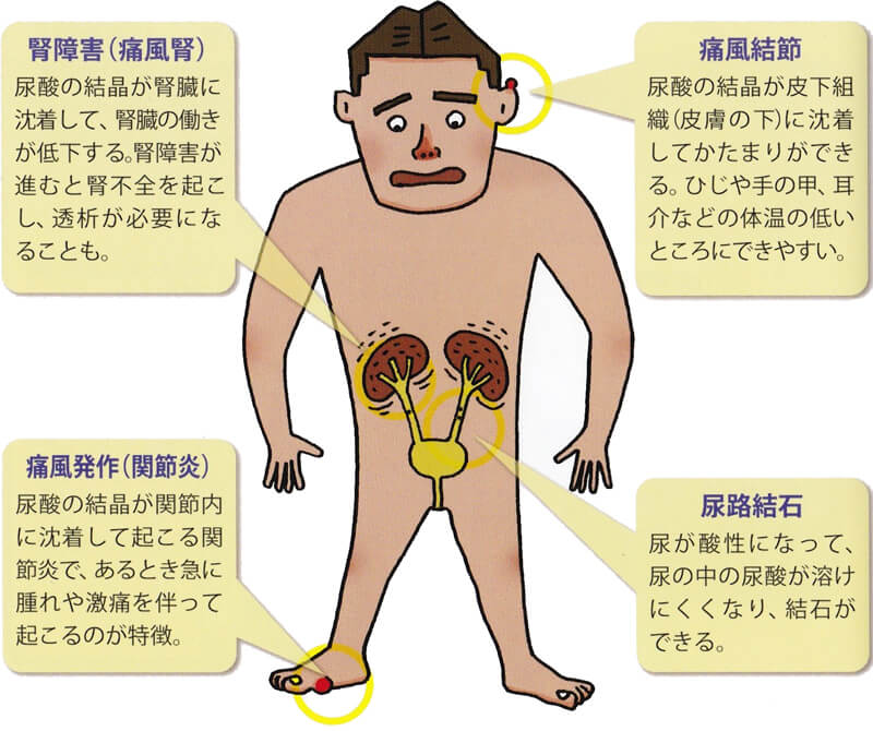 尿酸値が高くなると起こりうる4つのリスク