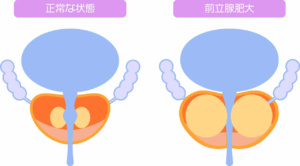 前立腺肥大症の原因は？加齢・生活習慣との関係を泌尿器科医が解説