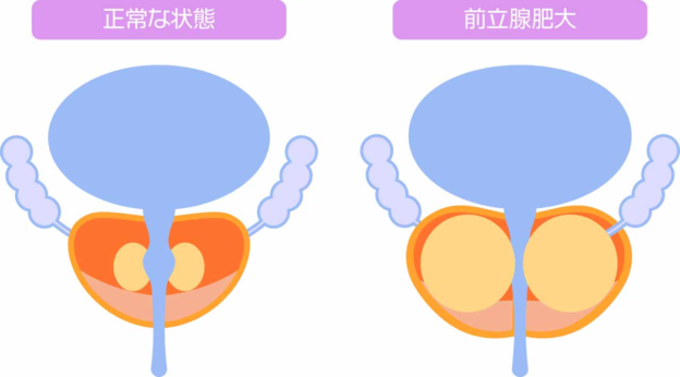前立腺肥大症の原因は?加齢・生活習慣との関係を泌尿器科医が解説