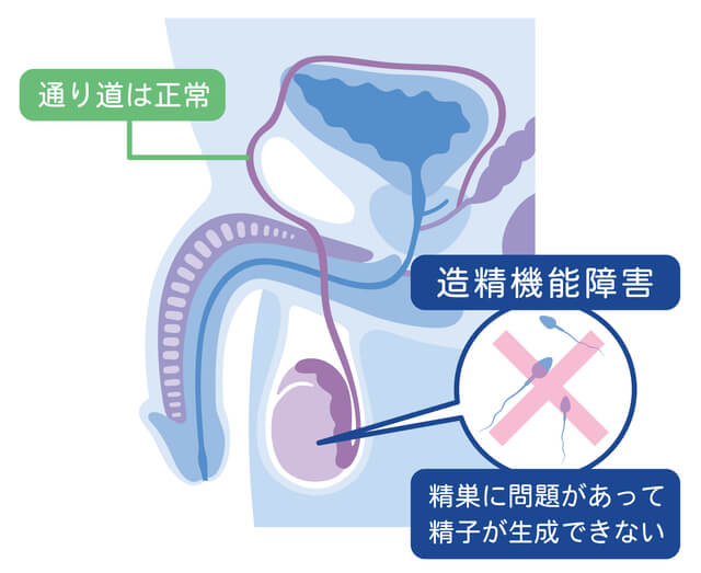 無精子症の一部原因｜精路通過障害とは？原因・検査・治療法をわかりやすく解説