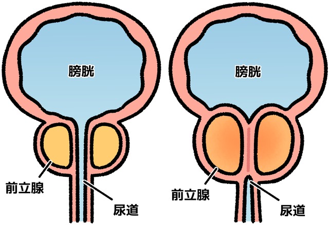 前立腺肥大と男性ホルモンの関係｜テストステロン・DHTの影響を泌尿器科医が徹底解説