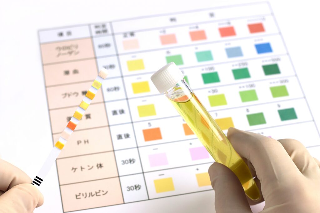 小児の血尿や学校での尿潜血について
