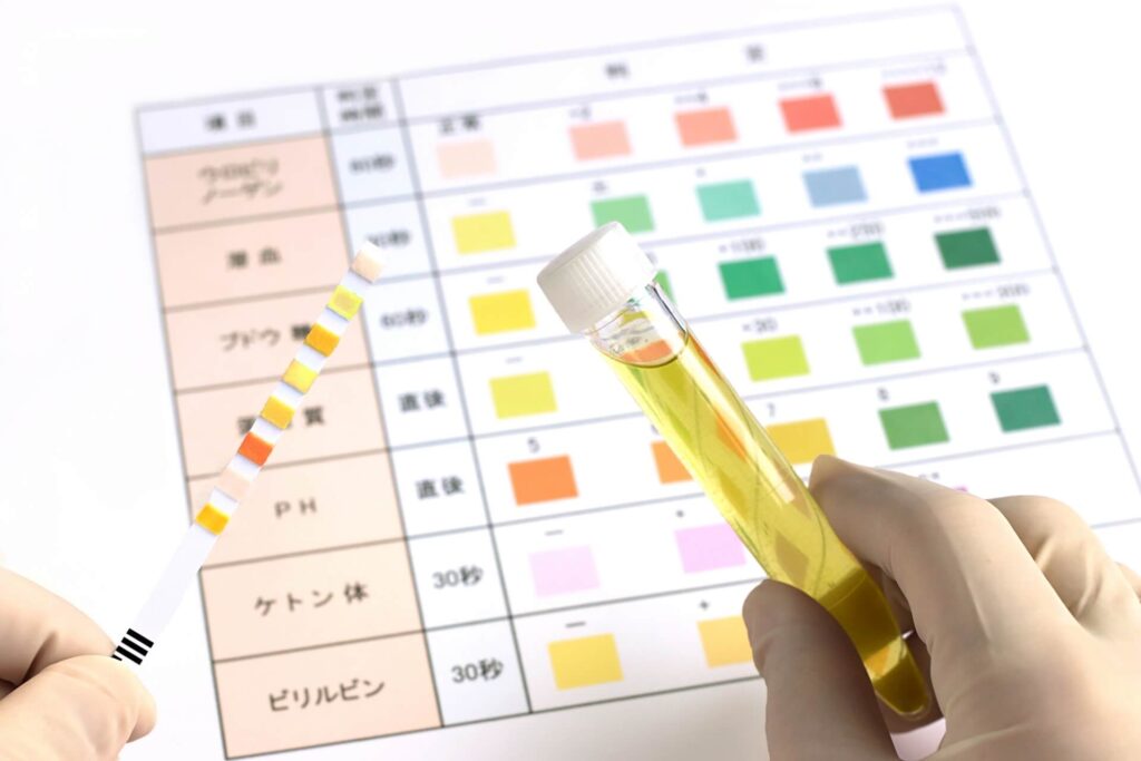 尿検査で指摘されやすい項目と、考えられる主な原因
